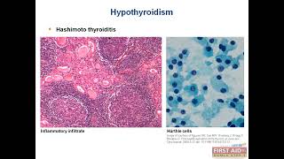 Difference BW Hyperparathyroidism and Hypoparathyroidism Endo pathology video part5 USMLE First Aid [upl. by Bing]