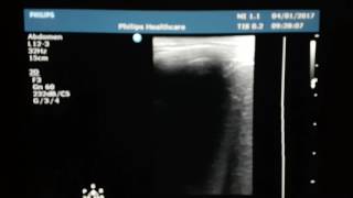 Hepatic Hydatid Cyst Ultrasound [upl. by Mooney]