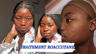 BILAN 1 AN APRÈS TRAITEMENT ROACCUTANECURACNÉACCUTANE TREATMENT PEAU NOIREDARK SKIN [upl. by Fabyola835]