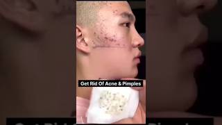 Get rid of Ance amp pimples  Glowing face home remediesnewsong skincareyt shortsdiybollywood [upl. by Euridice]