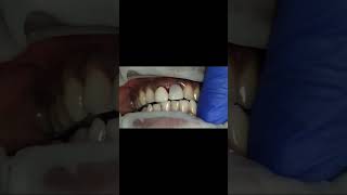 Upper centralIncisor same day implant and crown occlusion check in protrusion [upl. by Oinotnas]