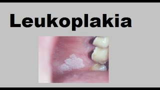 Leukoplakia [upl. by Eadahc428]