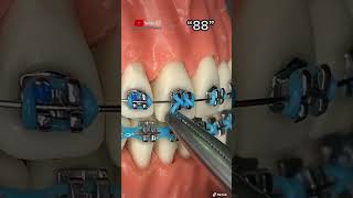 ¡Diferentes formas y estilos de instalar los módulos elásticos de color en los Brackets metálicos [upl. by Diann]