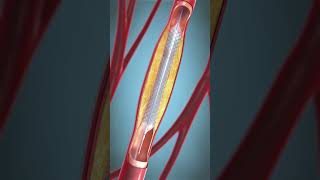 procedure of angioplasty shorts viralshorts [upl. by Krishnah]