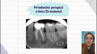 Lesiones periapicales [upl. by Odragde760]