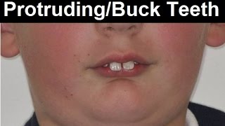 What Causes Protruded Teeth Buck Teeth Frontal Teeth Tipping Forward by Dr Mike Mew [upl. by Absalom775]