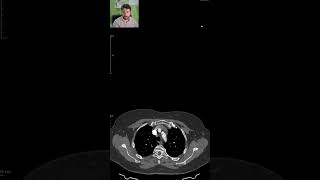 PAIN and MISSING PULSE in the left arm  CT SCANS Ep 15 ctscan medicalimaging angiography [upl. by Roti739]