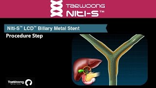 NitiS™ LCD™ Biliary Metal Stent Procedure step Animation NitiS™ LCD™ 胆道メタリックステント 施術の流れ [upl. by Ttesil]