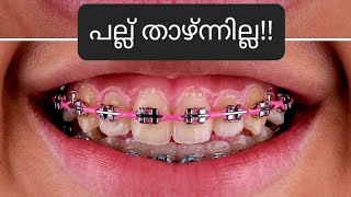 പല്ല് താഴ്ന്നില്ല pallil kambi idunnath malayalam braces pallil kambi  kambi  dental palludr [upl. by Eiramnerual324]