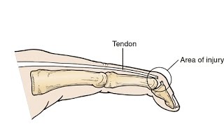 Que es el Mallet Finger  Rehabilitación [upl. by Atiuqram]