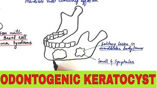 Odontogenic Keratocyst  Clinical Radiographic and Histopathologic Features [upl. by Sandeep]