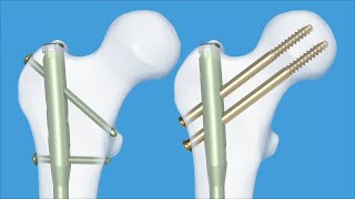 Femur  Fractures 32ABC 31B  Intramedullary Nailing Using the Expert Antegrade Femoral Nail A2FN [upl. by Einnej]