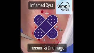 Inflamed Cyst Incision amp Drainage [upl. by Gereron]