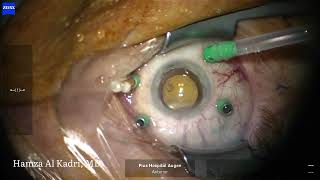 Vitrectomy for total rhegmatogenous retinal detachment with retinal folds und PVR [upl. by Kylen]