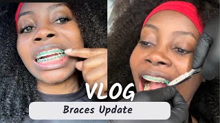 Braces Appointment Its the end of this braces journey  Progress check Vlog adultbraces [upl. by Kepner369]