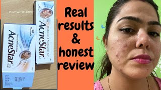 Acnestar Gel amp Acnestar soap Review amp results HOW TO GET RID OF ACNE FAST Pimples blackheads [upl. by Yak]