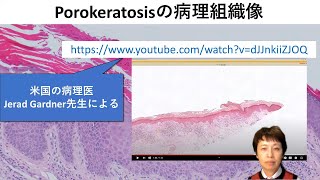 Porokeratosisの病理組織像の解説動画 [upl. by Robina]