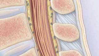 Comment pratiquer une ponction lombaire [upl. by Aiuqat]