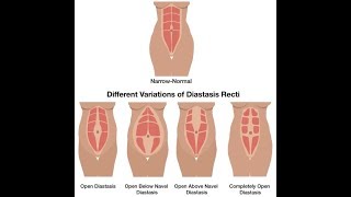 IM HAVING HERNIA AND DIASTASIS REPAIR SURGERY [upl. by Voltmer]