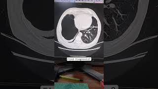 Chest CT Scan Results What Doctors Look For 2024radiology radiologytutorial health [upl. by Euginom874]