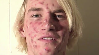 ZIT FACE GUY  PIMPLE ACNE EXPLOSION [upl. by Ennovoj268]