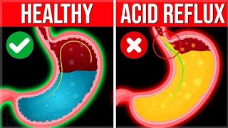 GERD  Acid Reflux  HeartBurn Treatment and Permanent Cure [upl. by Havot314]