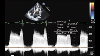 MS Quantifications Pressure half time PHT [upl. by Fotinas]