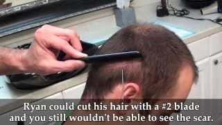 Dr Brett Bolton Revolutionary Hair Transplant [upl. by Yrmac97]