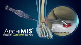 ArchiMIS  Precision Autograft Delivery  Launch Video [upl. by Hamel]