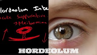 Hordeolum  hordeolum internum  hordeolum externumStye [upl. by Occor]