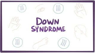 Down syndrome trisomy 21  causes symptoms diagnosis amp pathology [upl. by Naig850]