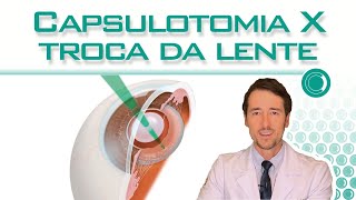 Trocar a lente intraocular após capsulotomia [upl. by Chiarra]