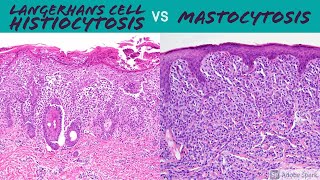 Langerhans Cell Histiocytosis vs Mastocytosis Hemepath for Dermatopathology Pathology Dermatology [upl. by Ainoet]