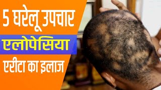 5 Home Remedies for Alopecia Areata Treatment of Alopecia Areata [upl. by Akanke370]