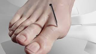 Minimally Invasive Hallux Valgus Bunion Surgery [upl. by Fiedling]