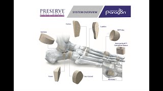 PRESERVE Allograft Bone Wedge Science amp Application in Foot amp Ankle Surgery [upl. by Friend840]