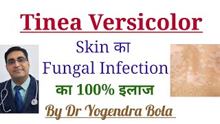 Tinea Versicolor Skin Infection ka 100 Treatment [upl. by Akeem]