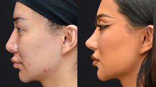 My 4th Nose Job Surgery Story Nikita Dragun [upl. by Ramoj22]