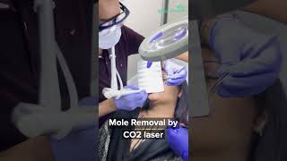 Mole Removal by CO2 Laser [upl. by Almeeta]