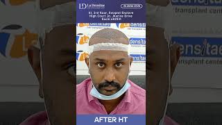 10th Months Result  7th Grade Baldness  3500 GRAFTS [upl. by Yra]