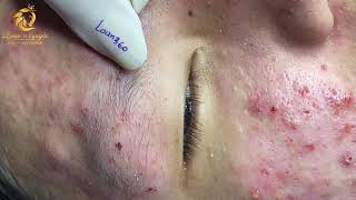 Treatment of acne tablets pustules and blackheads 360  Loan Nguyen [upl. by Sukul]