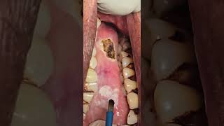 Verrucous carcinoma toungue  excision with cautery laser  Dr Hitesh Patel [upl. by Maurits913]