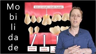 Vi que Tenho Dentes Moles  O que Devo Fazer [upl. by Etana805]