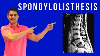 Spondylolisthesis Cause Symptoms and treatment for pain relief [upl. by Brodsky]