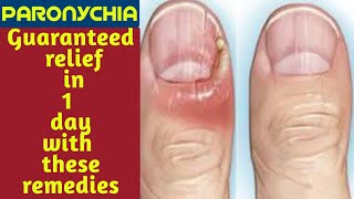 Paronychia finger home remedies  Paronychia fungal nail infection  Paronychia nail home remedies [upl. by Sollows]