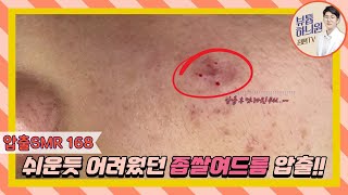 압출SMR 168 모델 최초 압출 후 덧나서 재내원한 케이스  20대 男 [upl. by Colbert]