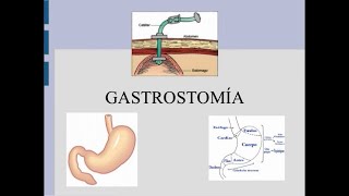 Que es gastrostomía [upl. by Ahseneuq482]