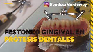 FESTONEO GINGIVAL 👅Prótesis Dental Inferior Parte3 ProtesisDentales [upl. by Gallager]