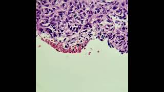 Dermatofibroma aneurismático e com hemossiderina [upl. by Kazmirci]