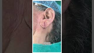 Ear Piercing Before amp After See the Difference Awish Clinic [upl. by Nedia]